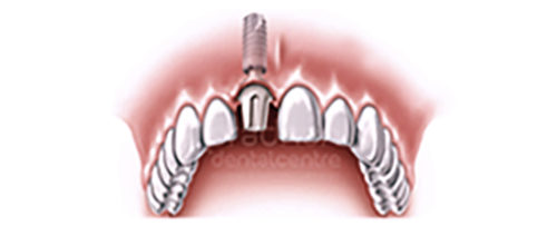 implants-dentistry-003
