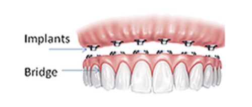 implants-dentistry-005
