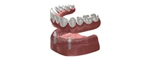 implants-dentistry-006